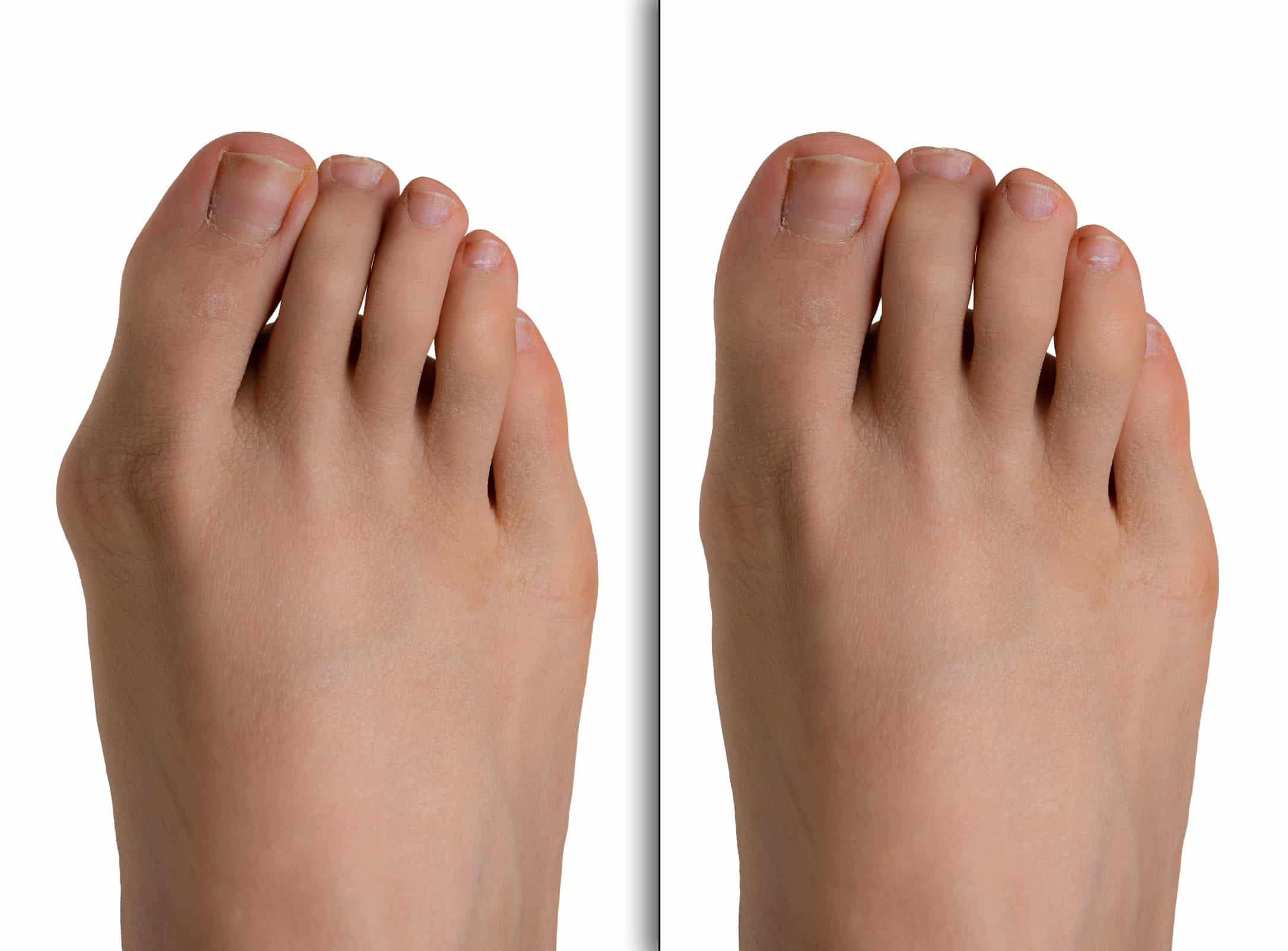 Fu&szlig;fehlstellung Hallux valgus