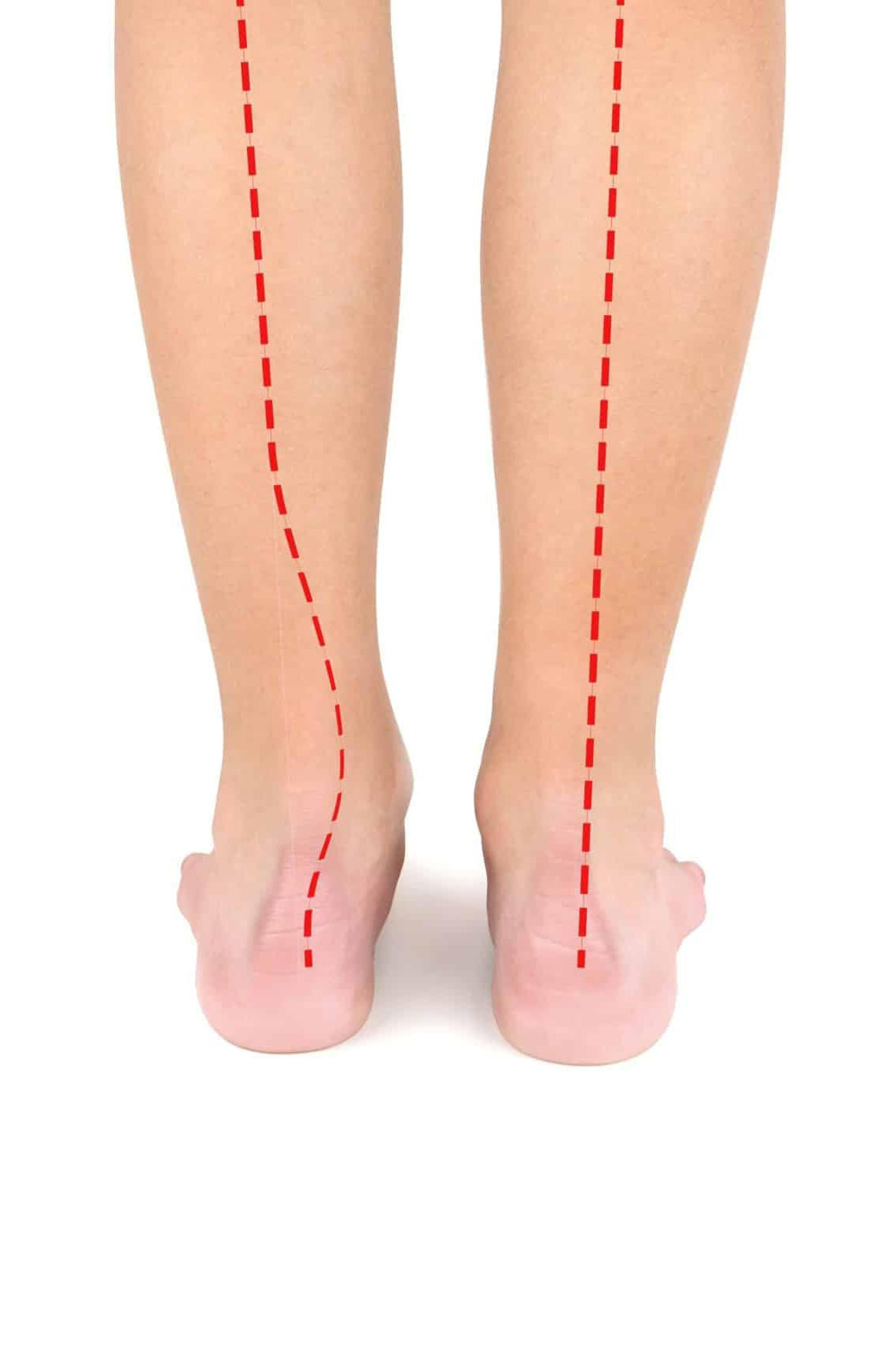 Unterschenkel, davon einer im Lot und der andere in Fehlstellung